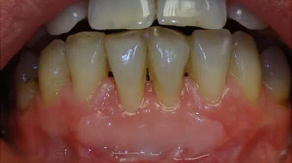 Czy dziąsła odrastają? Poznaj prawdę i skuteczne leczenie recesji