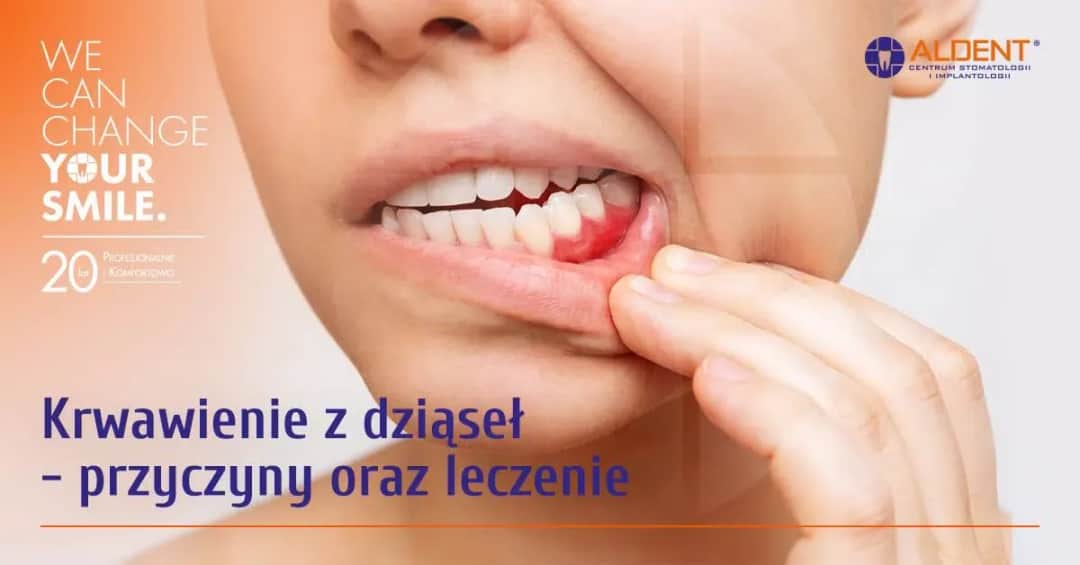 Jak zatamować krwotok z dziąsła? Szybkie sposoby i przyczyny