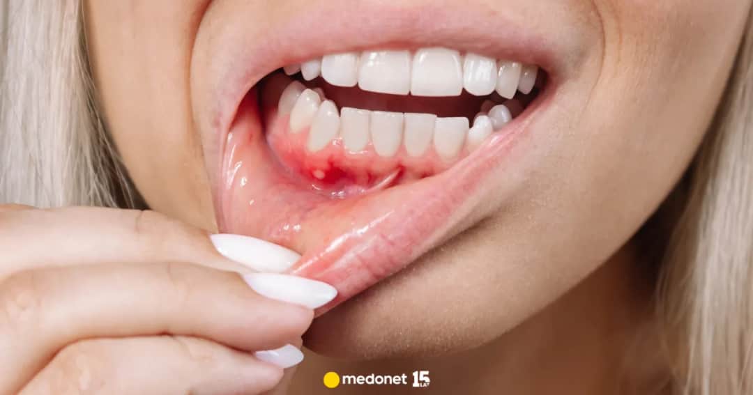 Zapalenie dziąseł: Objawy, przyczyny i kiedy iść do dentysty