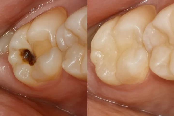 Wypadła plomba? Jak zabezpieczyć ząb i uśmierzyć ból