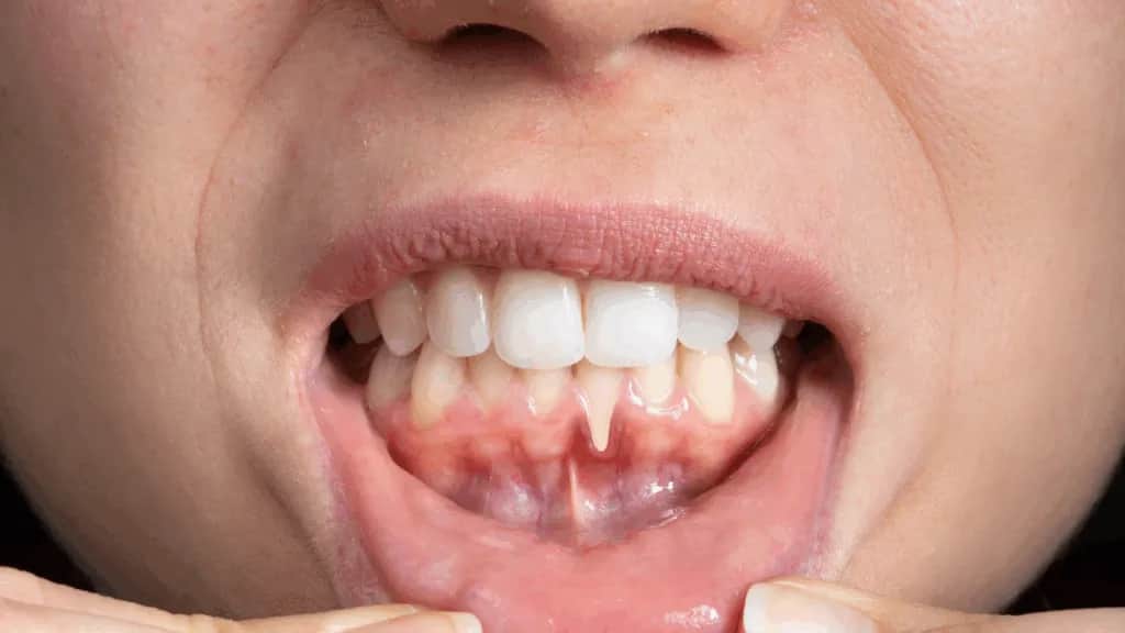 Przeszczep dziąsła: czy warto? Koszty, korzyści, ryzyko i fakty