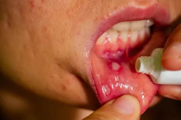 Nadżerki w ustach: domowe sposoby, leki i dieta szybka ulga