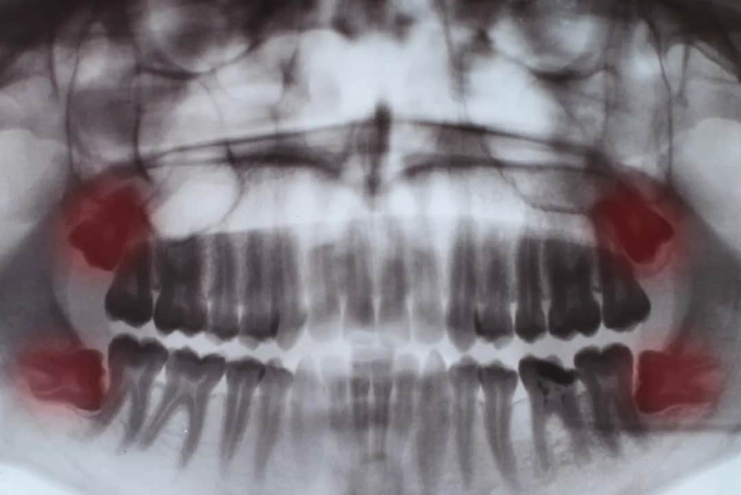 Kiedy rosną zęby mądrości? Objawy, ból i kiedy iść do dentysty