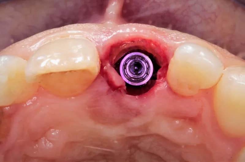 Implant zęba: cały proces leczenia krok po kroku