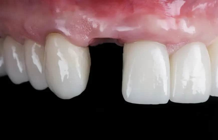 Krwawienie po wyrwaniu zęba: Ile trwa? Jak tamować? Kiedy do dentysty?