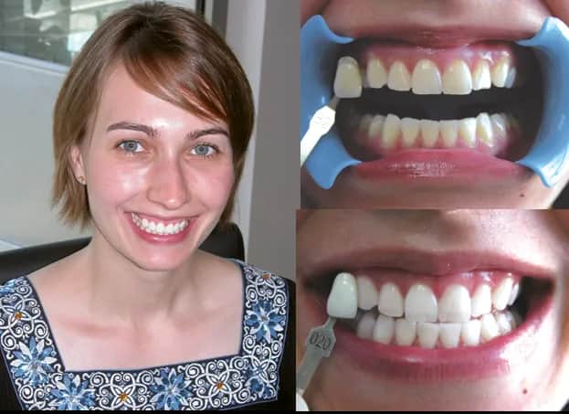 Wybielanie zębów u dentysty: Czy warto? Opinie, koszty, efekty